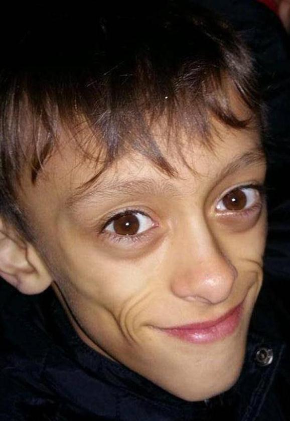 11岁男孩瘦骨嶙峋 像70岁老人 被称"外星人"