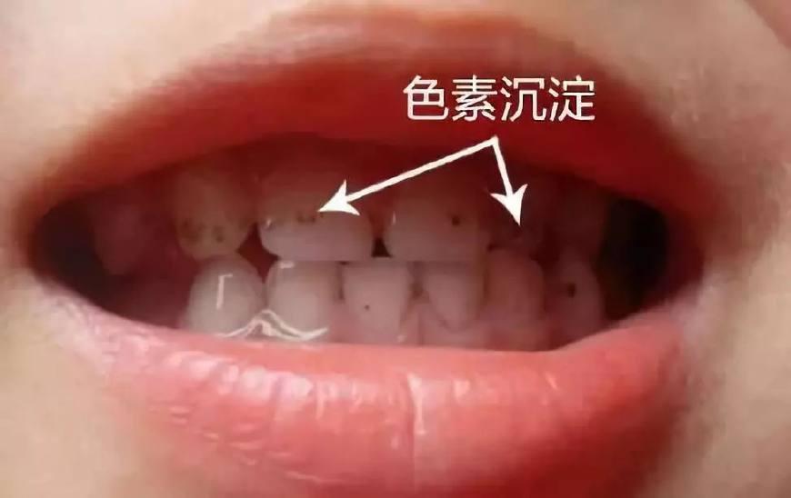 宝宝一口"小黄牙",都是妈妈惹的祸!