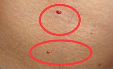 身上出现这种小红点千万别忽视可能是肝在向你求救