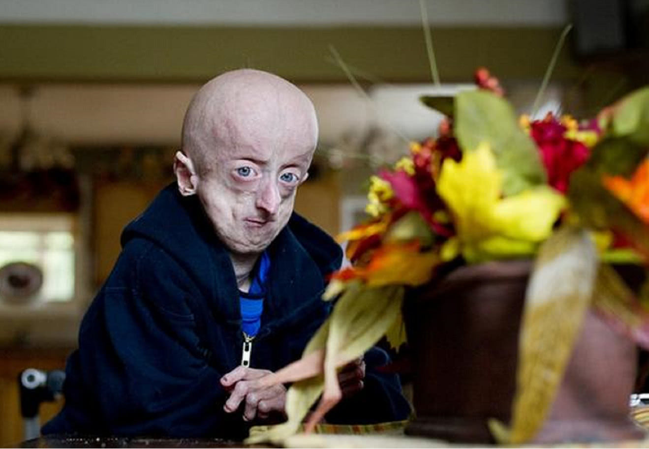 男子患有早衰症,16岁的年龄看着像60岁,邻居都以为是外星人