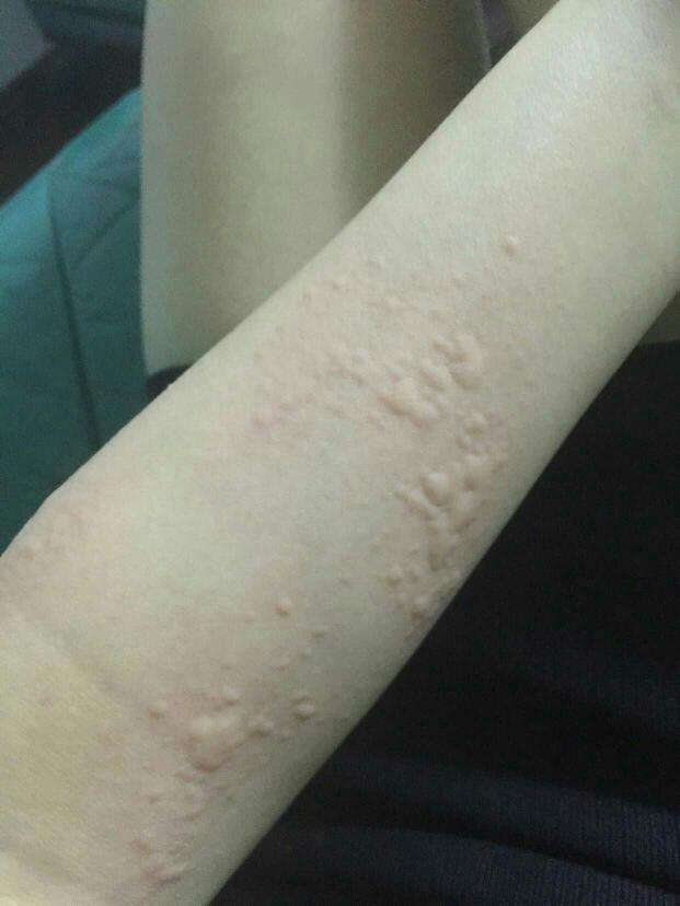 荨麻疹还可以这样治?小小益生菌一天两包,治好荨麻疹不复发!