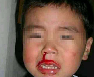 6岁男孩突然流鼻血不止,只因妈妈抱的不对,结果让人无法接受