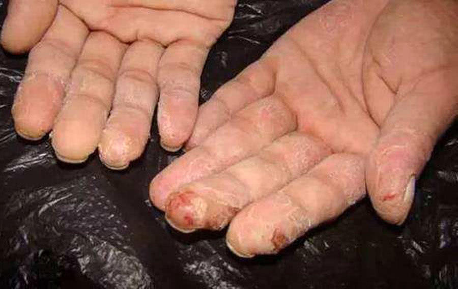 钓鱼人不得不防的3种病,其中"香虎手"最难治