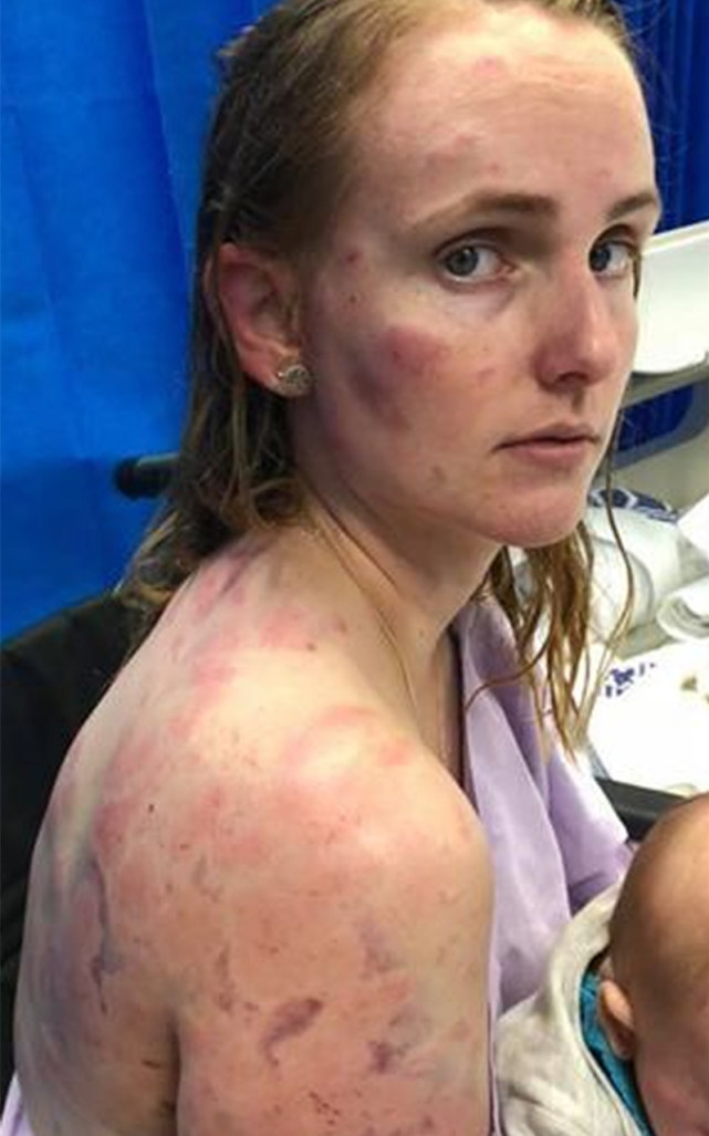 年轻妈妈开车遭遇冰雹袭击用身体护住婴儿自己却遍体鳞伤