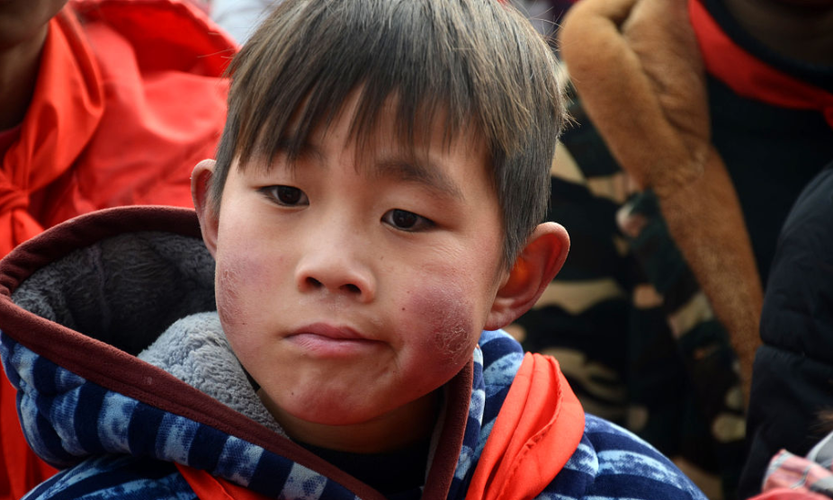 冬季脸部冻伤怎么办? 教你3招治疗冻伤, 第二年不复发__财经头条