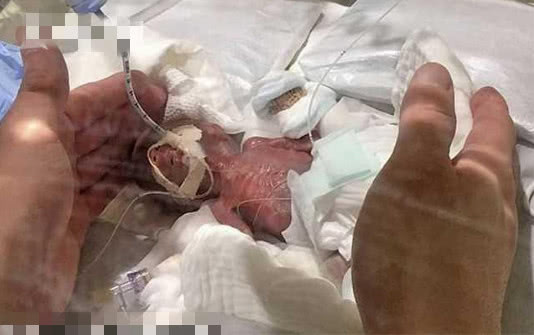 "世界最小男婴"出生时仅5个鸡蛋重,一年后,他的变化令人感叹