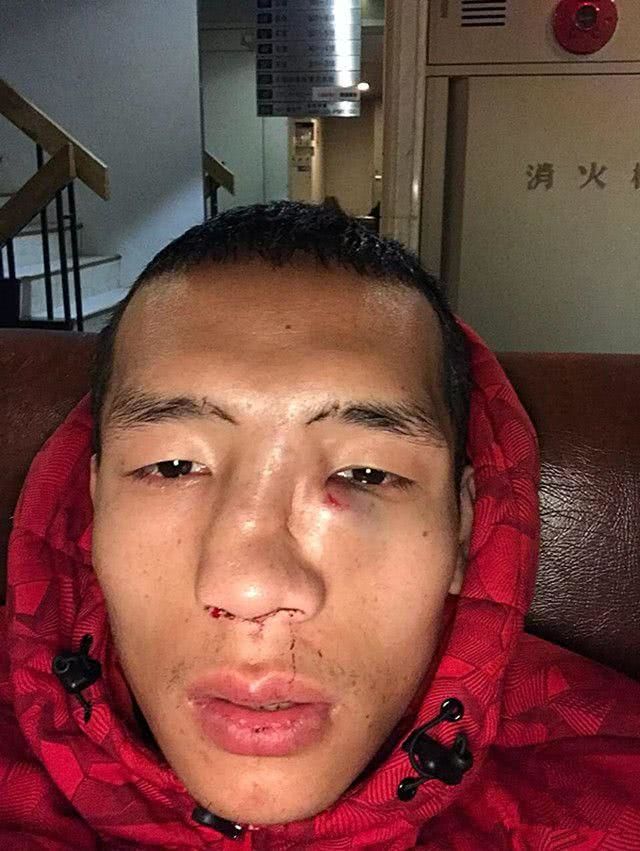 韦宪钱被日本拳手打歪了鼻子网友还敢叫嚣邱建良吗