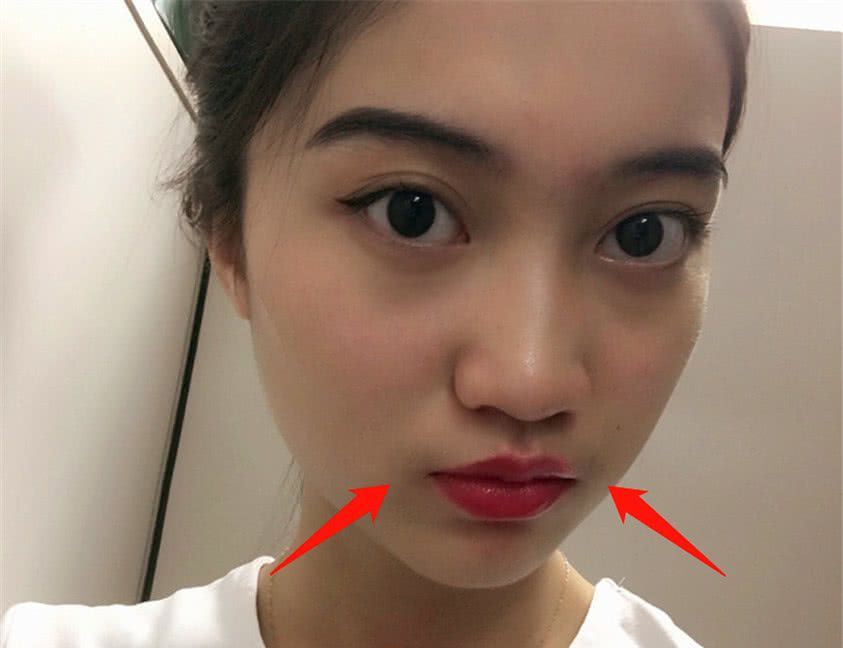 为什么有些女生的嘴唇上会突然长出小胡子专家得治