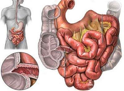 确诊肠癌入院,医生直言:这种"肉"是祸根|肠道|肠癌|便秘_新浪新闻