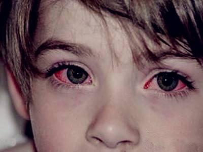 结膜炎|宝宝|宝妈_新浪新闻