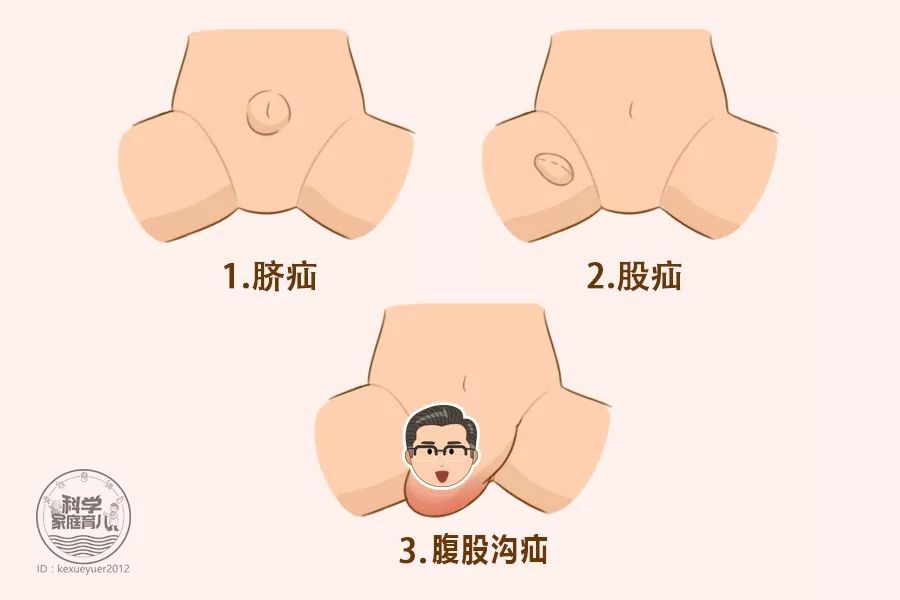 腹股沟|宝宝|疝气_新浪新闻