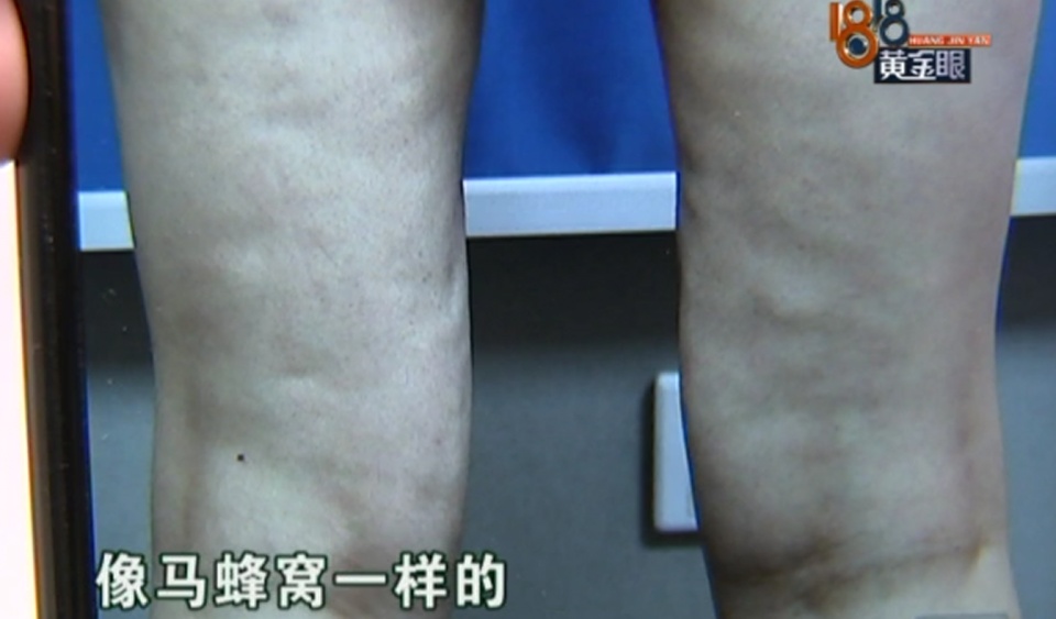 女子花10万做隆胸, 抽脂后大腿凹凸不平, 索赔五十万块钱遭拒!