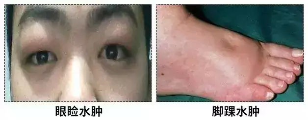 那一夜默默无闻的肾病偷走我第一次眼泪