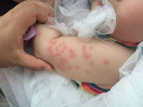 4岁男宝胳膊上长了几颗"痘痘",医生挤出的东西,直接吓哭妈妈