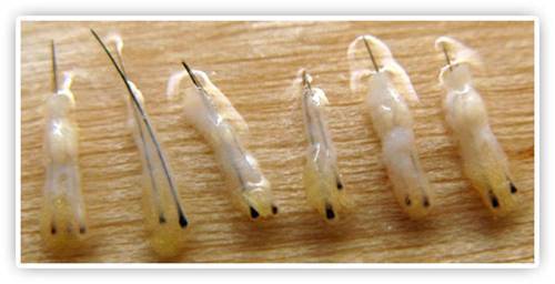 毛囊单位什么意思?植发1000单位能长1000根头发吗?