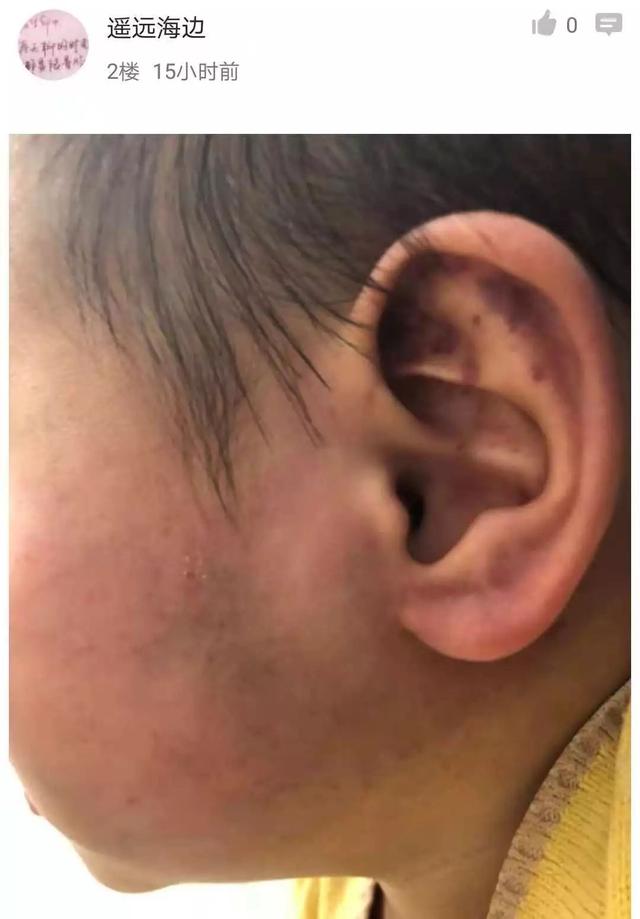从照片中可以看出,孩子整个右脸有大片黑紫色的淤血,耳朵部分受伤尤其