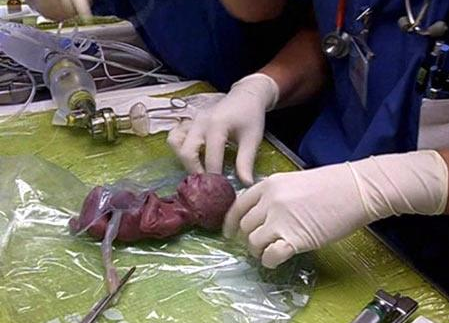 去年10月一名美籍女子,更是在他的博客中发布了她21周的胎儿照片,这个