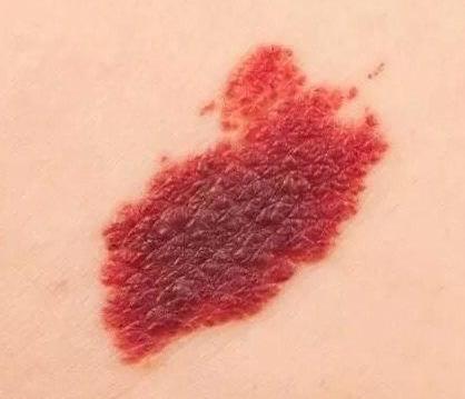 嘟嘟妈教你快速识别宝宝身上的鹤吻痕、胎记、胎痣、血管瘤哦|血管瘤|胎记|吻痕_新浪新闻