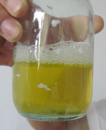 糖尿病患者注意了4个症状一同出现肾衰竭可能已经找上你