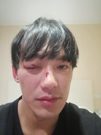 出道,近年来将重心转往拍戏,日前他在拍摄新剧时却传出受伤意外,眼睛