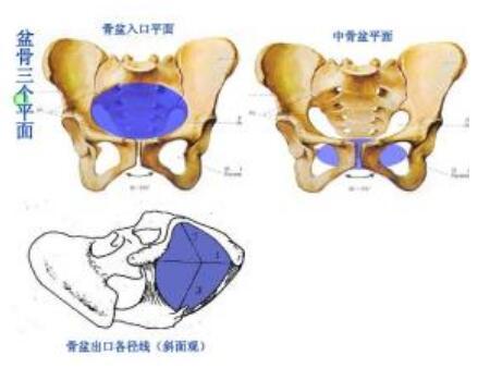 这属于均小骨盆.若是胎儿不大,胎位正常,头盆相称,宫缩好,可以试产.