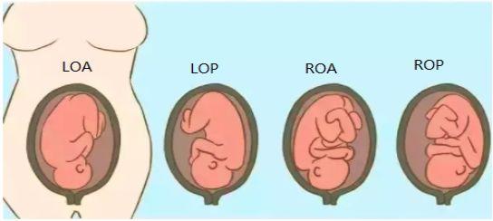 左枕前(loa),左枕后(lop),右枕前(roa),右枕后(rop)胎位一般分为头位