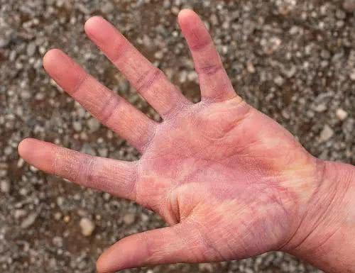 治疗手足皲裂冻疮原来可以这么简单治疗手足皲裂偏方大全