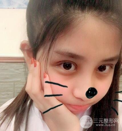 开眼角前后对比图 开眼角恢复过程日记分