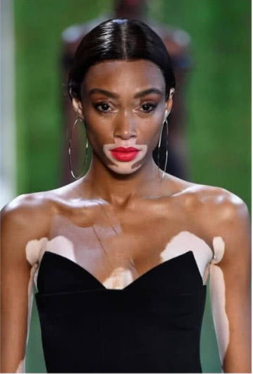 为了走维密,白癜风超模不惜"漂白"黑皮肤,难怪白的那么对称