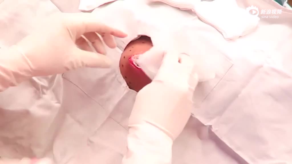 这个网红专门给人挤痘痘 58秒视频引围观