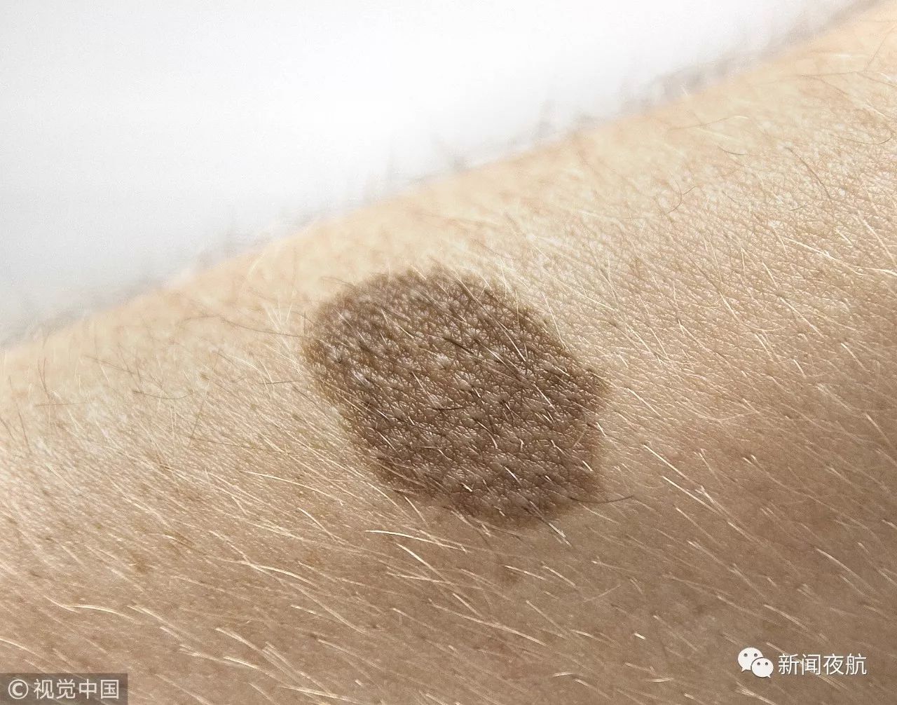 男子抠了一下痣,最后竟成了瘤……当心这几种痣!