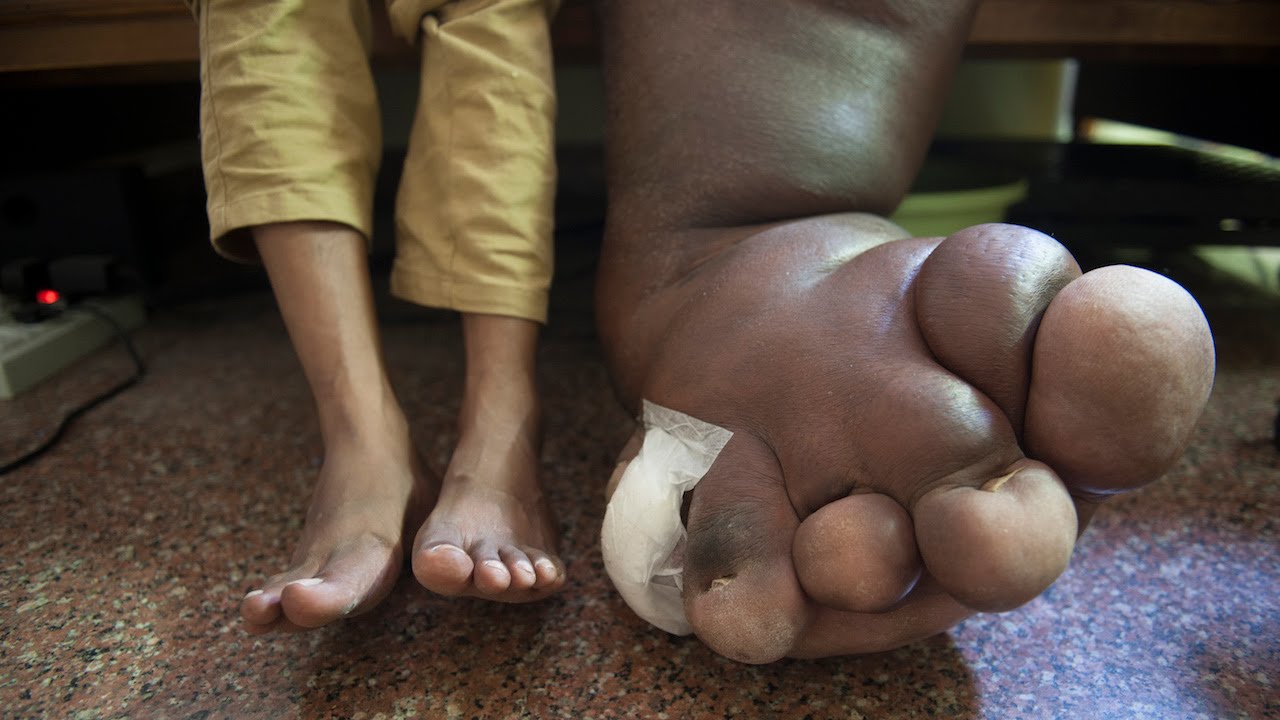 6岁男孩手被卡在扶梯4小时,拔出后爸妈看到被吓坏