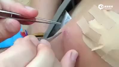 手臂上有三个洞 竟然揪出了这么多虫