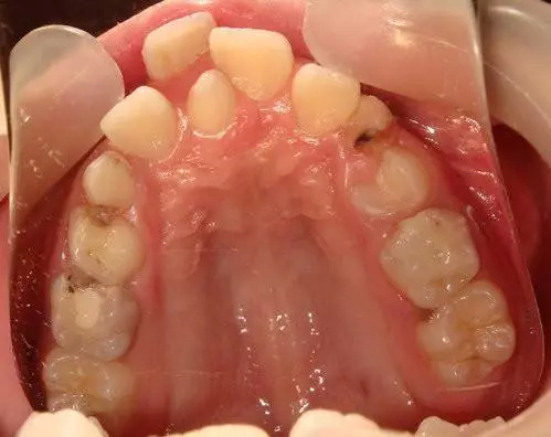 正文               多生牙,也叫额外牙.