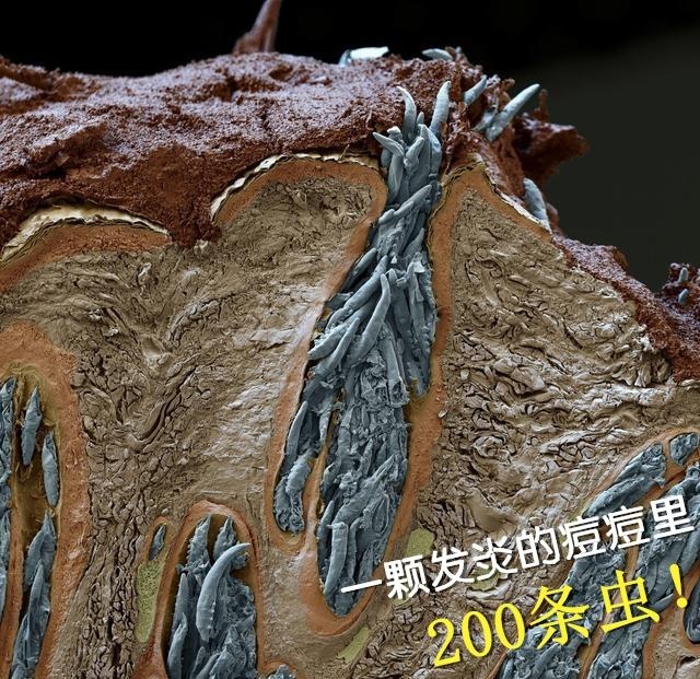 快起床除掉|螨虫|皮肤|毛孔_新浪新闻