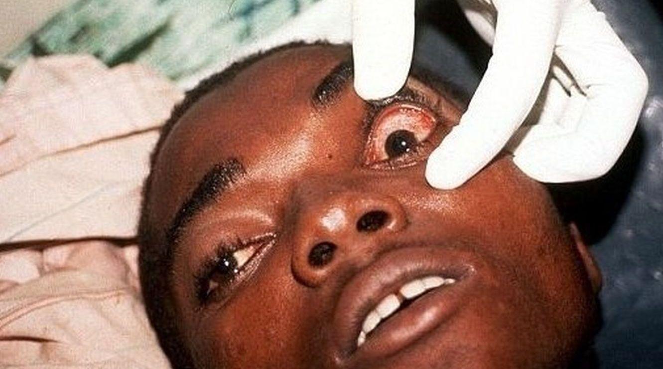 比艾滋病更厉害的病毒,感染后全身融化