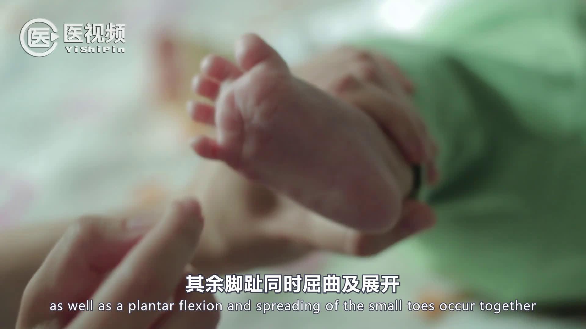 医学双语课程:婴儿的babinski巴宾斯基反射