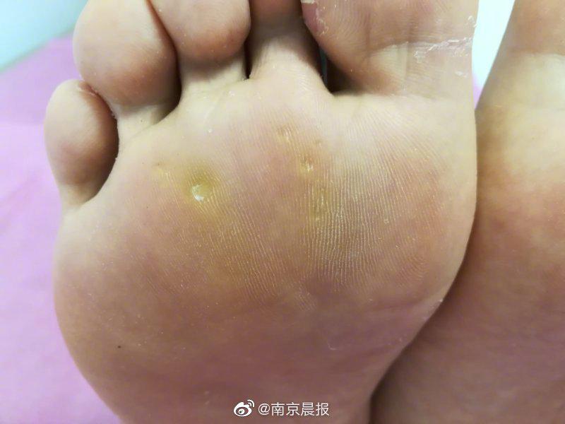 6岁男孩脚底长"老茧" 小心像"鸡眼"又像"老茧"的皮肤病