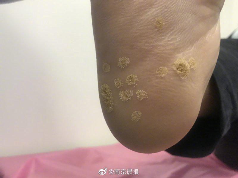 6岁男孩脚底长"老茧" 小心像"鸡眼"又像"老茧"的皮肤病