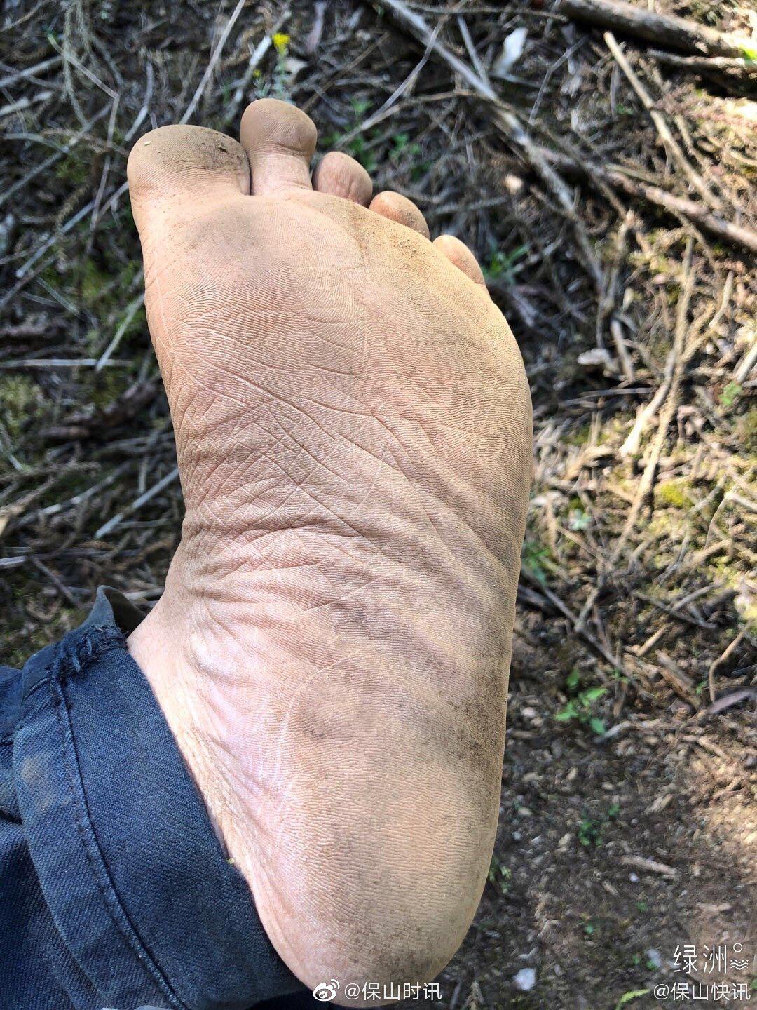 分享保山快讯 的@绿洲 动态: 「脚底板戳了个刺」