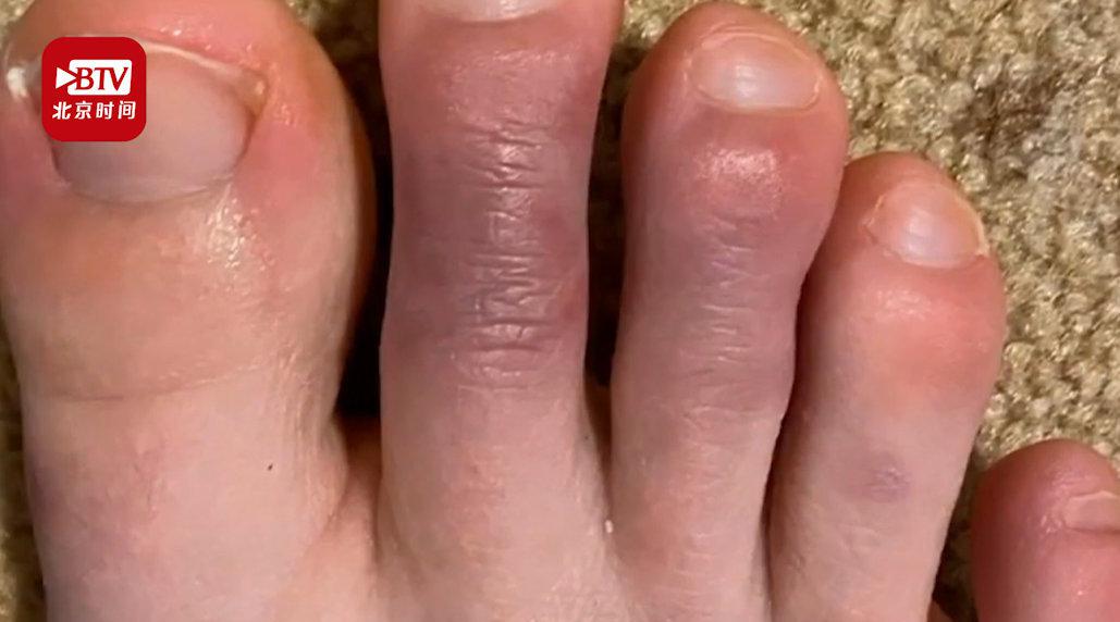 脚趾发紫,起疹子,像冻疮? 医生:或为新冠肺炎早期症状