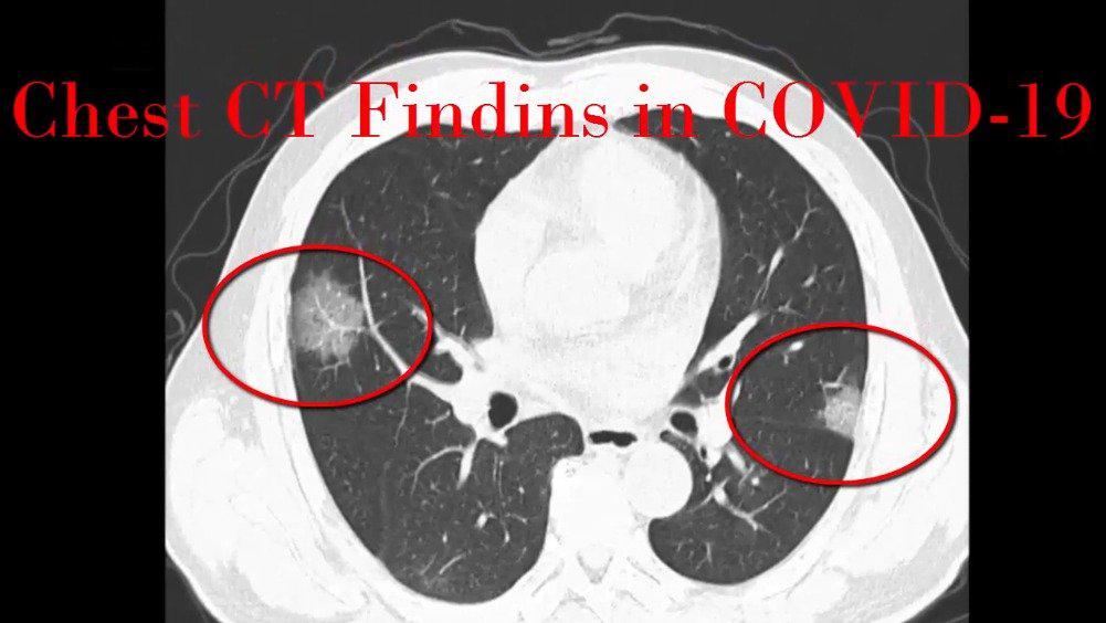 新冠肺炎的ct图像