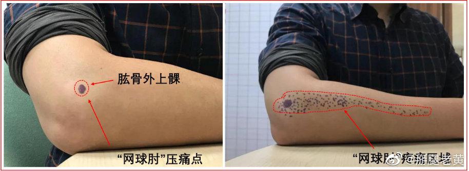 网球肘的高发人群有哪些