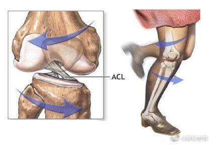 前交叉韧带受伤之后,多数会很快就出现关节积血