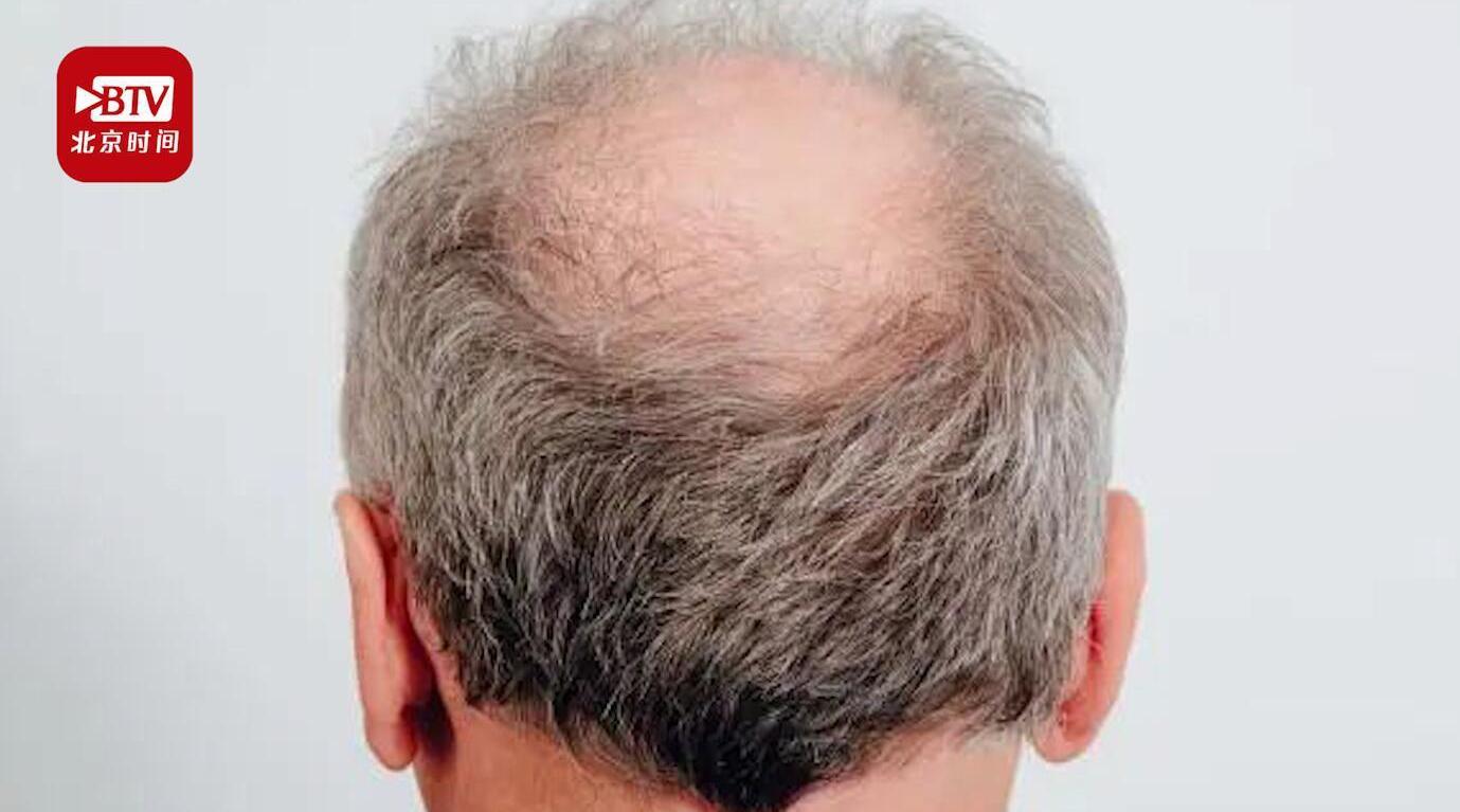 英国科学家:秃顶男性感染新冠后重症风险更高_手机新浪网