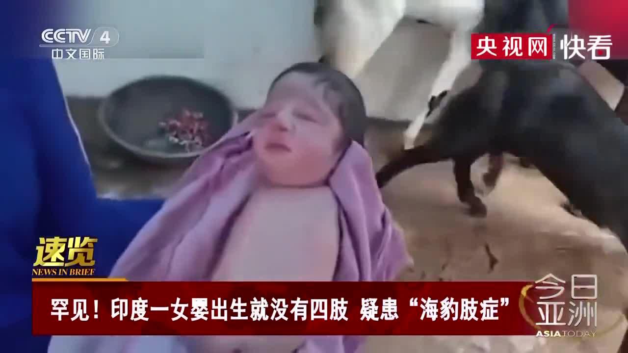 印度一女婴疑患 海豹肢症 出生就没有四肢 手机新浪网