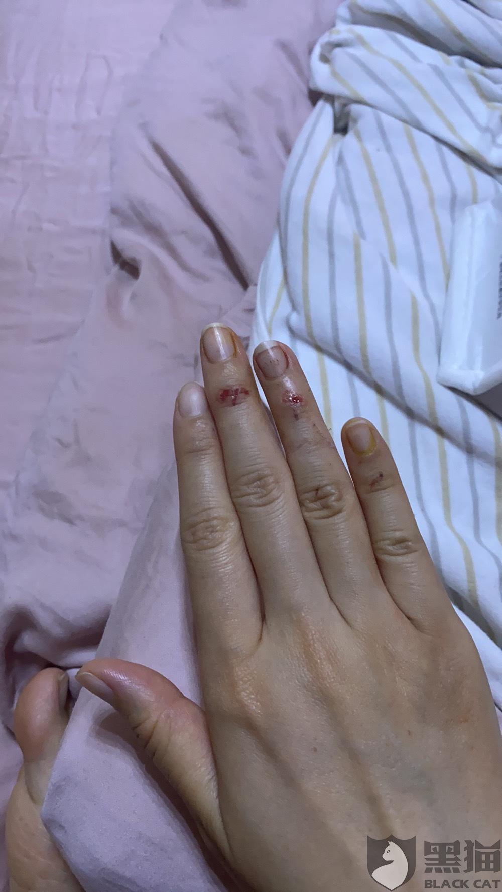 京东618购买自营爱仕达炒菜锅安装玻璃锅盖过程中突然爆炸手已经扎伤