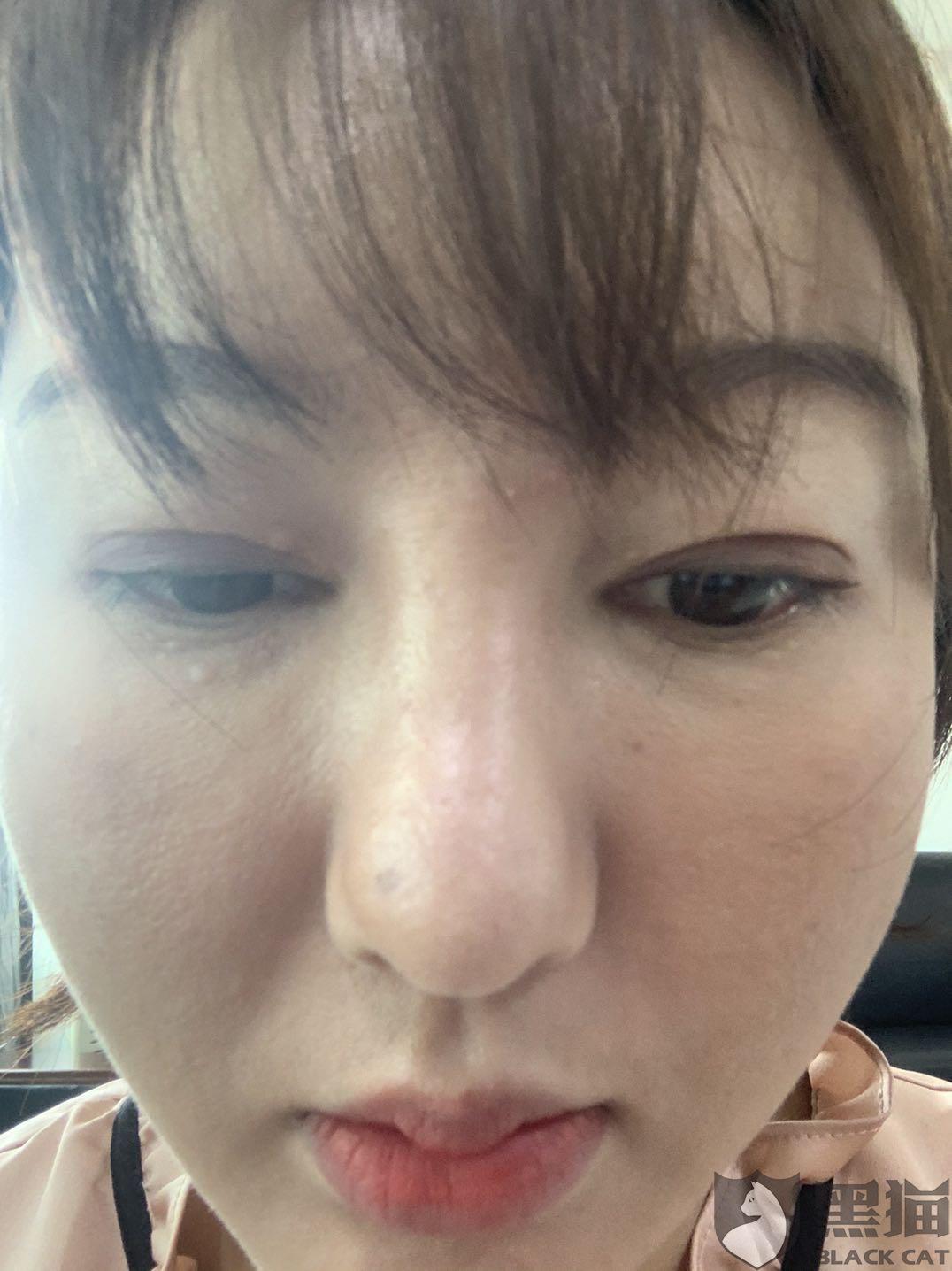 黑猫投诉:我在长沙微丽丝医疗美容做的半肋骨隆鼻手术失败,假体晃动
