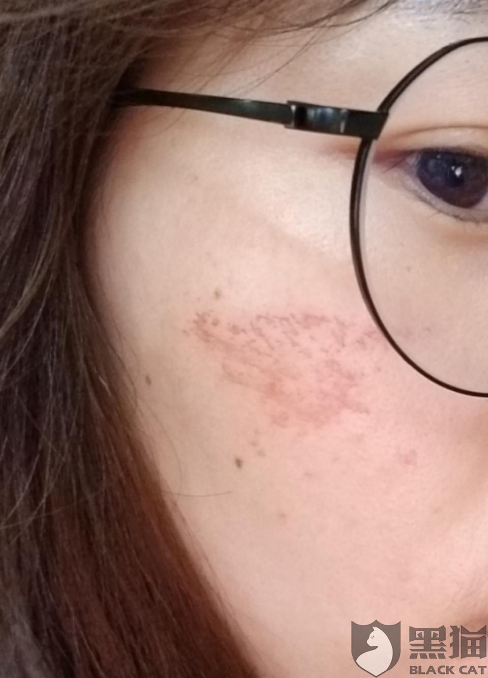 黑猫投诉:南京乐玛婚纱摄影拍摄期间损伤客户脸部黑猫投诉 2020-07-23