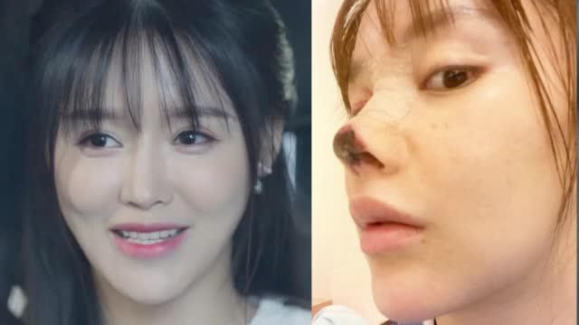 演员高溜整容失败鼻尖坏死:丢了工作,还要赔200万违约金